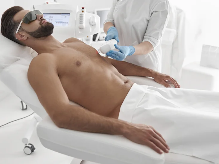 Top Advantages of Laser Hair Removal For Men